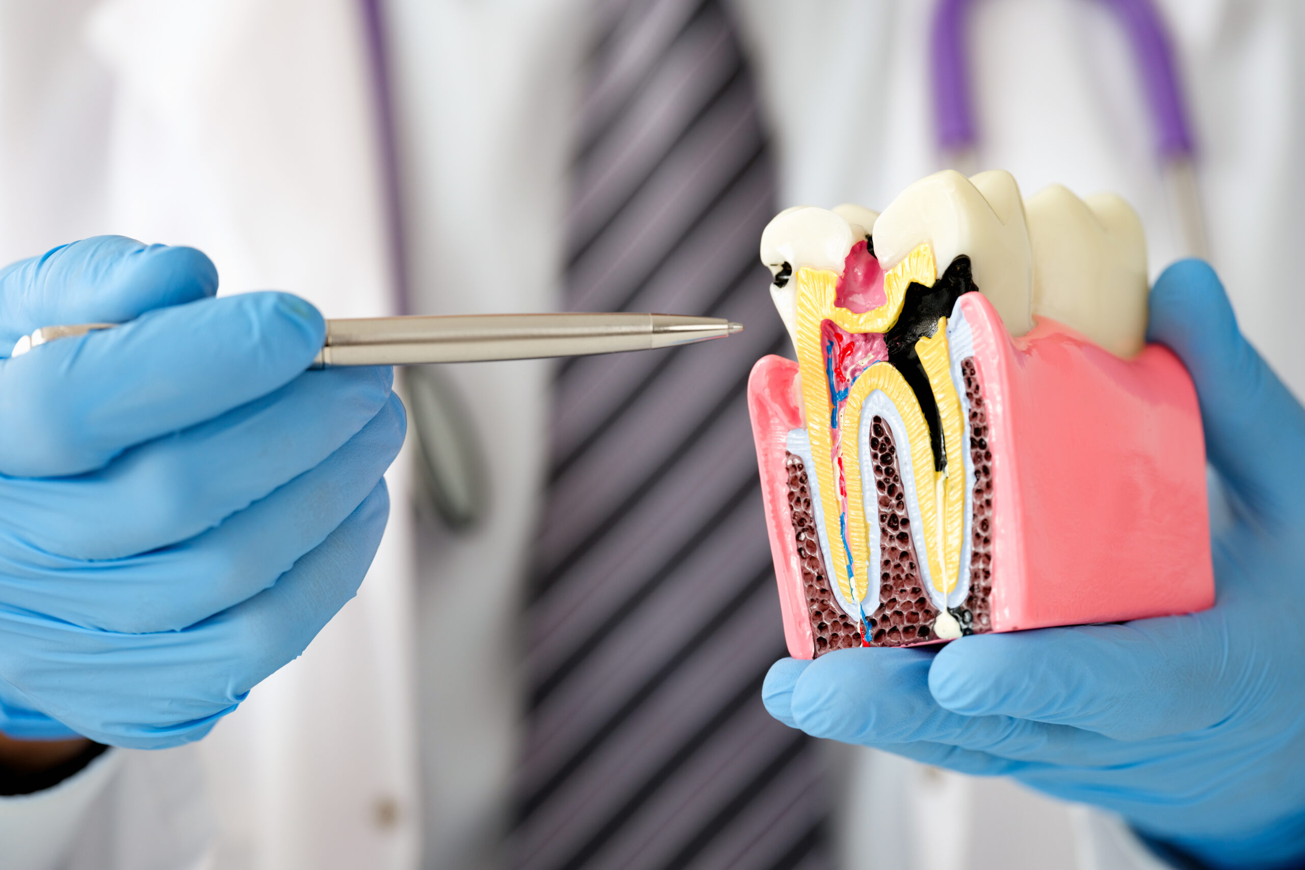 歯の模型で説明する医師